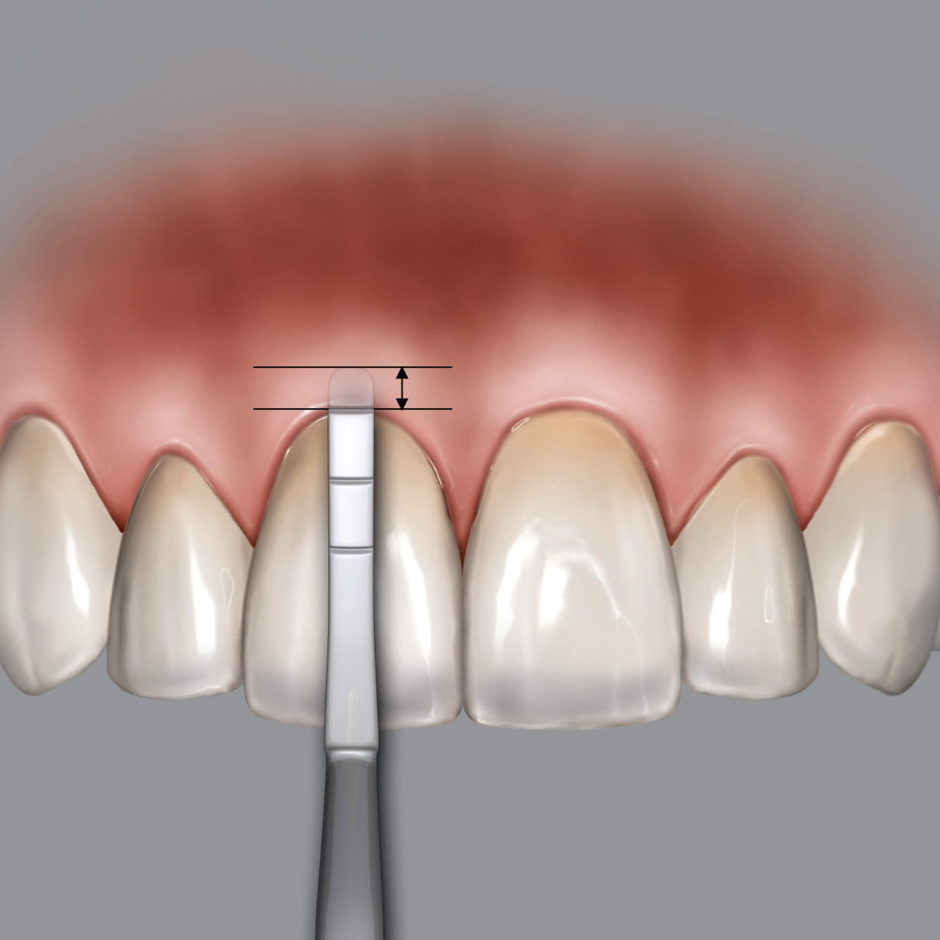 Chu Gauge Sounding Set