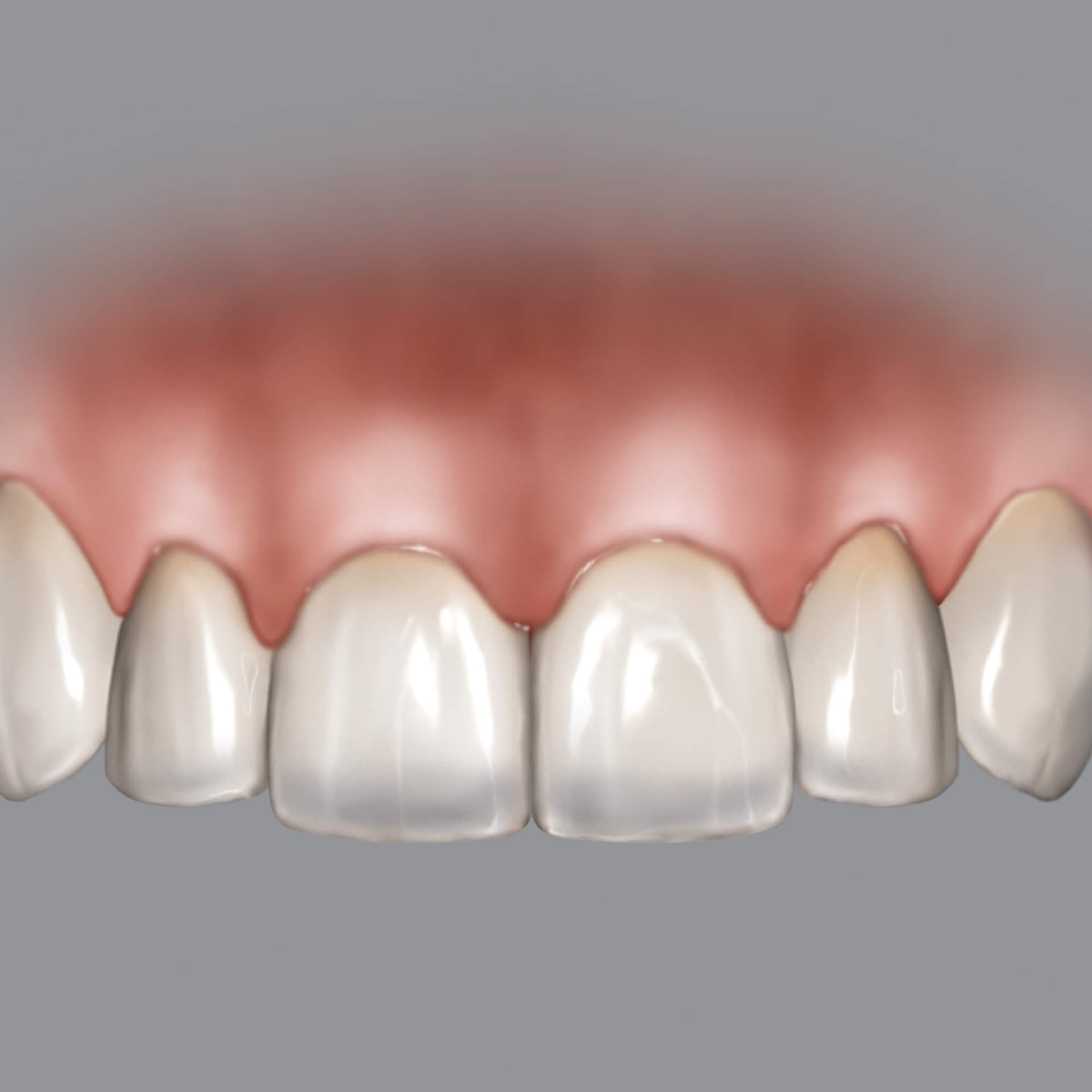 Chu Gauge BLPG Replacement Tips (3 Tips)